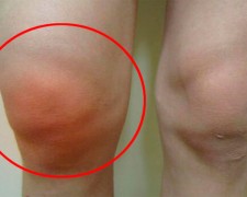 Что такое гемартроз коленного сустава — чем грозит несвоевременное лечение