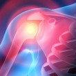 Причины появления субакромиального бурсита плечевого сустава — чем опасно заболевание