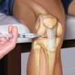 Уколы в коленный сустав при артрозе: препараты