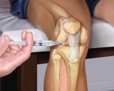 Уколы в коленный сустав при артрозе: препараты