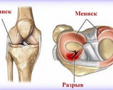 Разрыв мениска