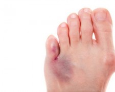 Перелом пальца на ноге