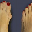 Косточка на большом пальце ноги — лечение в домашних условиях