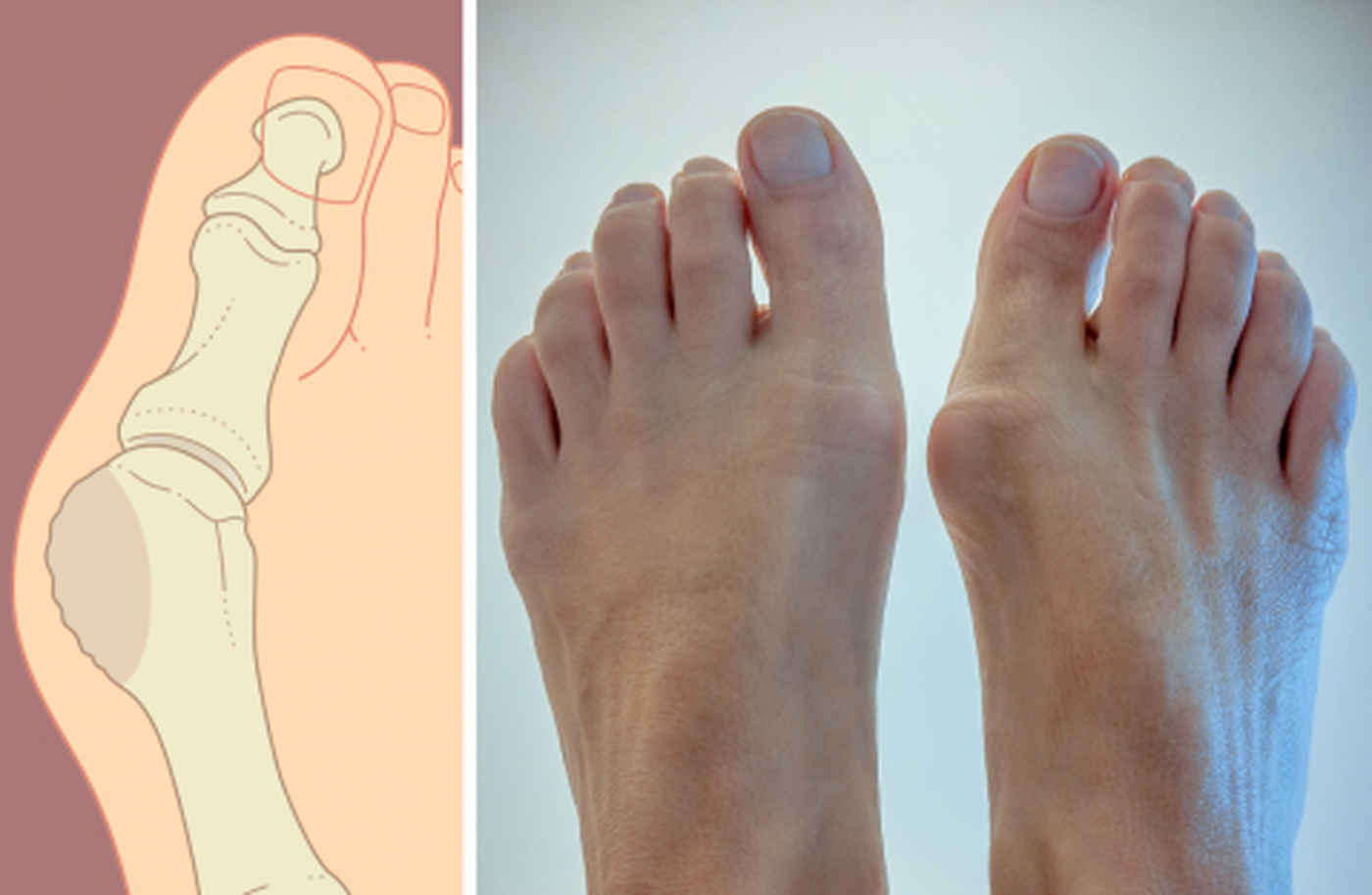 Косточка на пальце ноги домашнее лечение thumbnail