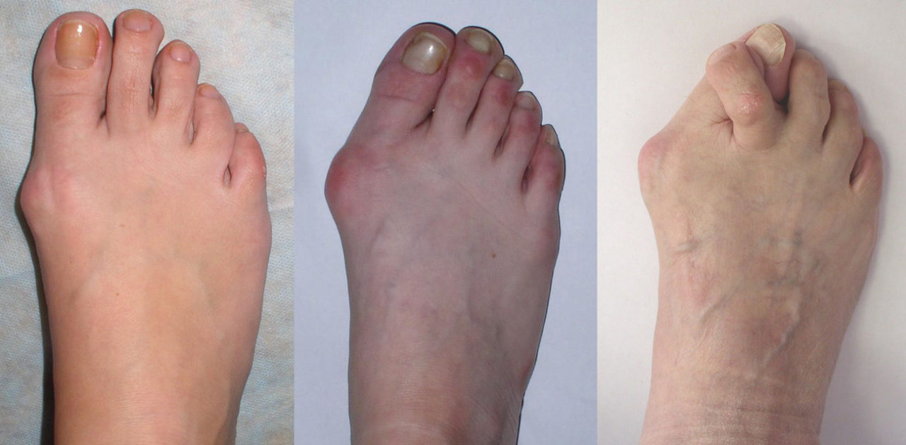 Лечение косточек на больших пальцах ног в домашних условиях thumbnail