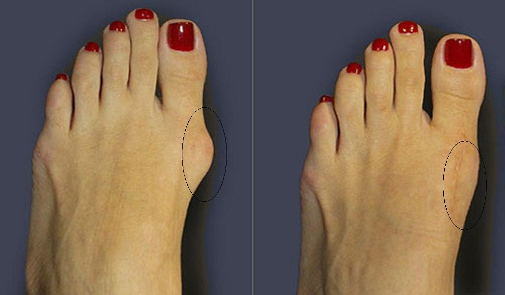 Большая косточка на большом пальце ноги лечение в домашних условиях thumbnail