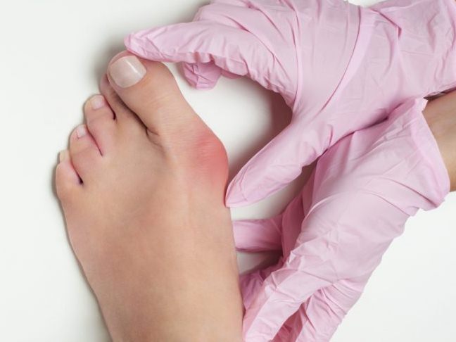 Способы лечения косточки на большом пальце ноги thumbnail