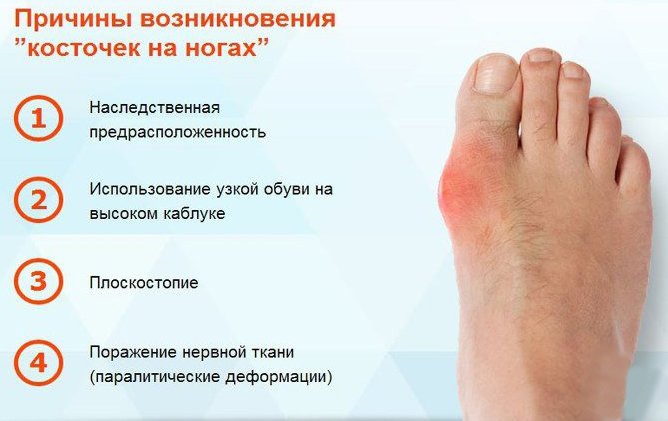 Косточка на большом пальце ноги лечение в домашних thumbnail