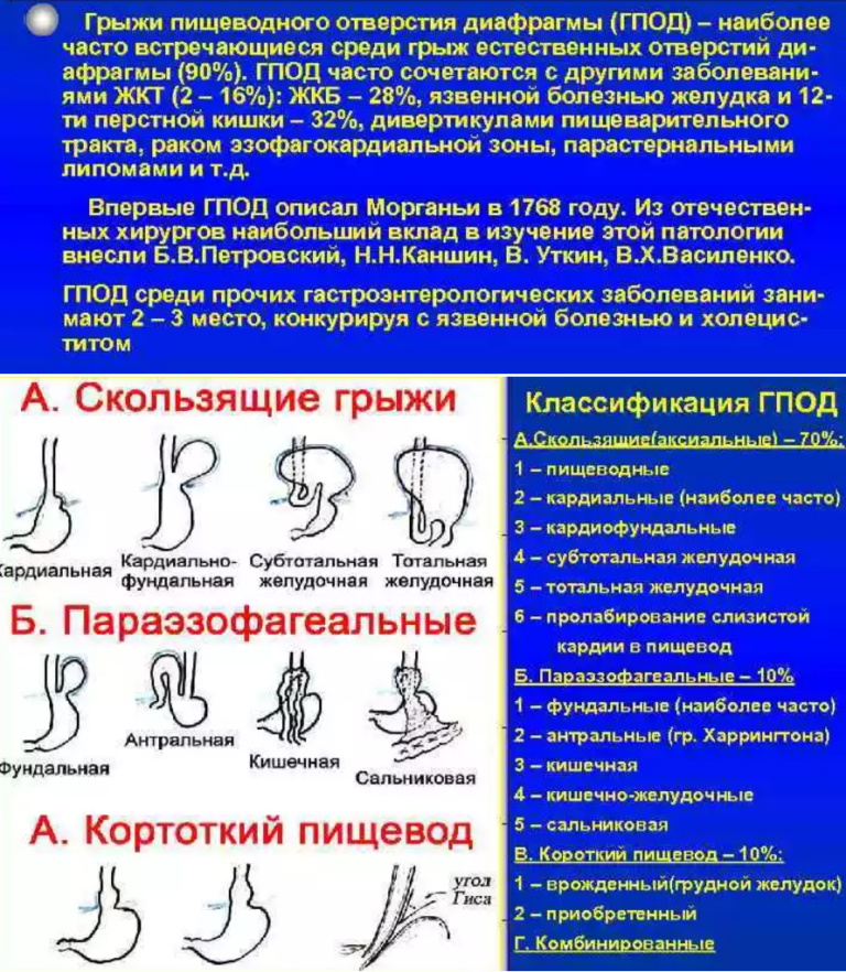 Грыжа пищеводного отверстия диафрагмы