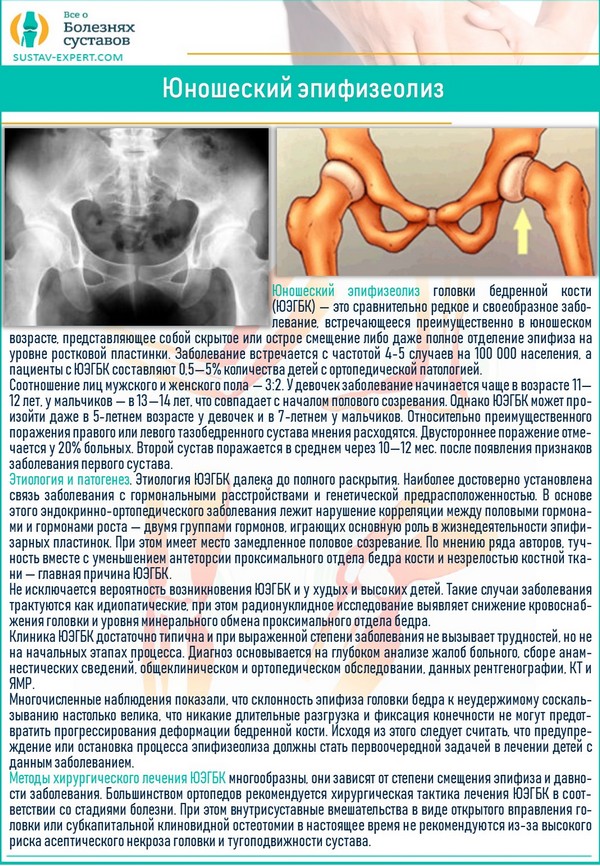 План лечения коксартроза