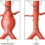 Аневризма аорты 
