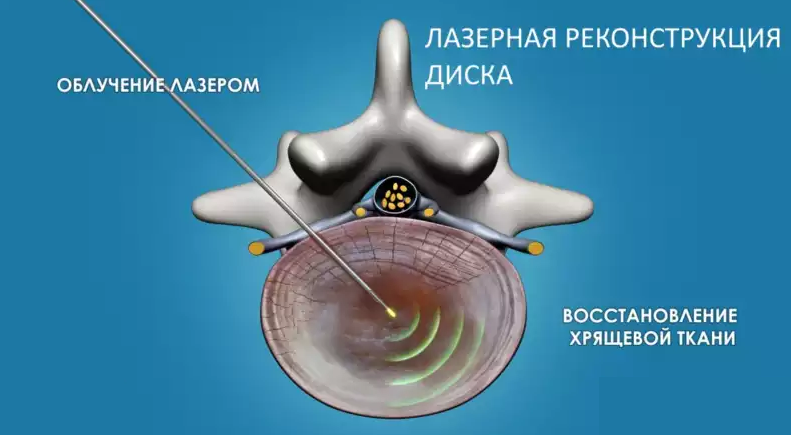Внутрь диска через тонкую иглу вводится лазерное световое волокно, по которому диск облучается импульсным инфракрасным лазером