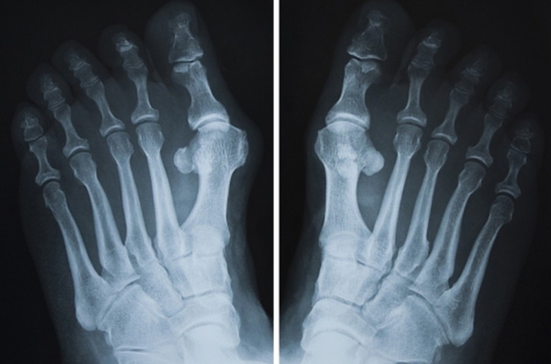 Очень часто при вальгусной деформации пальца стопы косточки появляются не только на больших пальцах ног, но и возле мизинца
