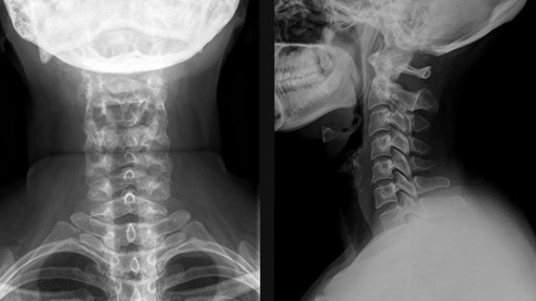 Рентген позволяет заметить отклонения в строении позвоночного столба