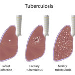 Туберкулез  