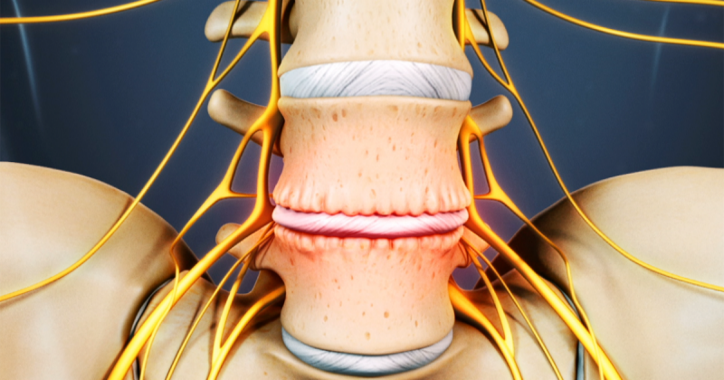 Остеохондроз — комплекс дистрофических нарушений в суставных хрящах