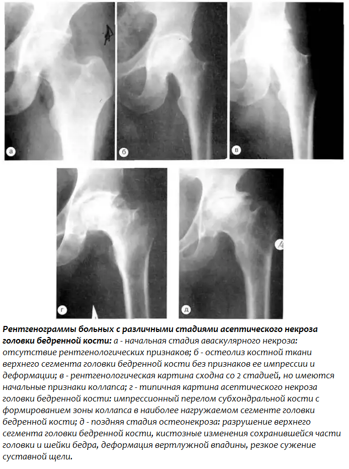 Рентгенограммы больных с различными стадиями асептического некроза головки бедренной кости: