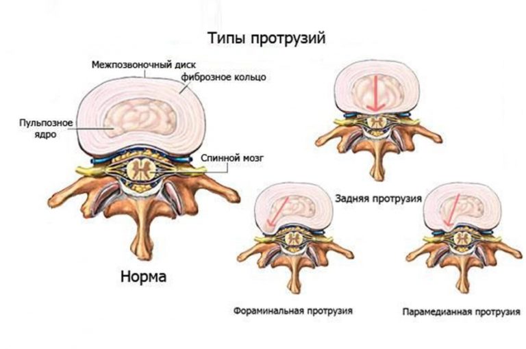 Мр картина дистрофических изменений пояснично крестцового отдела позвоночника дорзальных экструзий