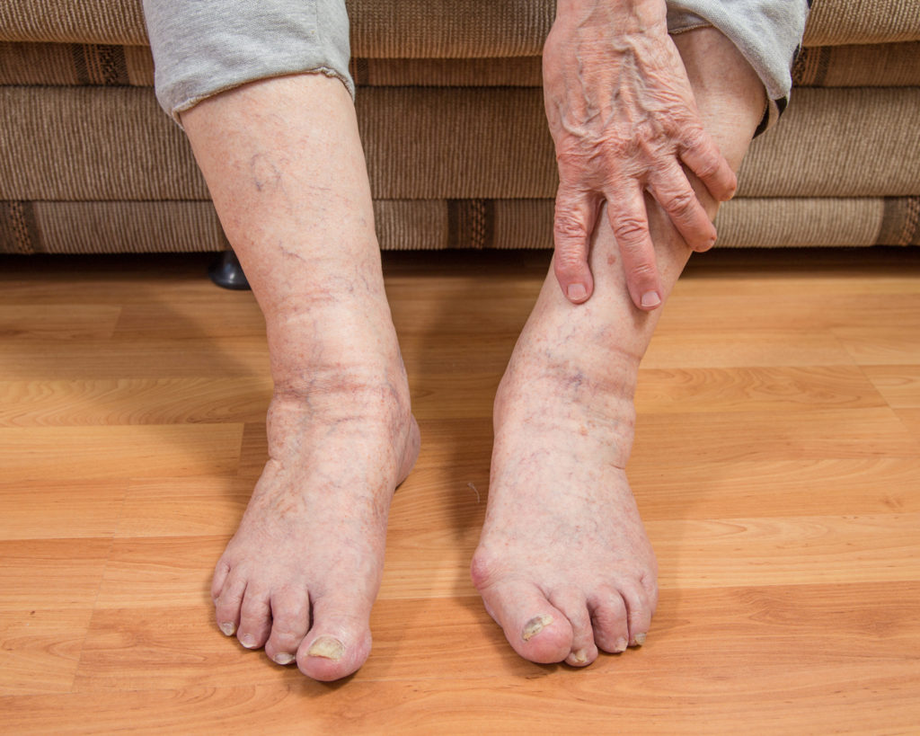 Отеки ног в области щиколотки причины и лечение thumbnail