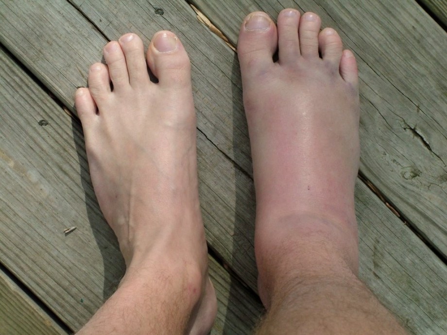 Отек лодыжки ног лечение thumbnail