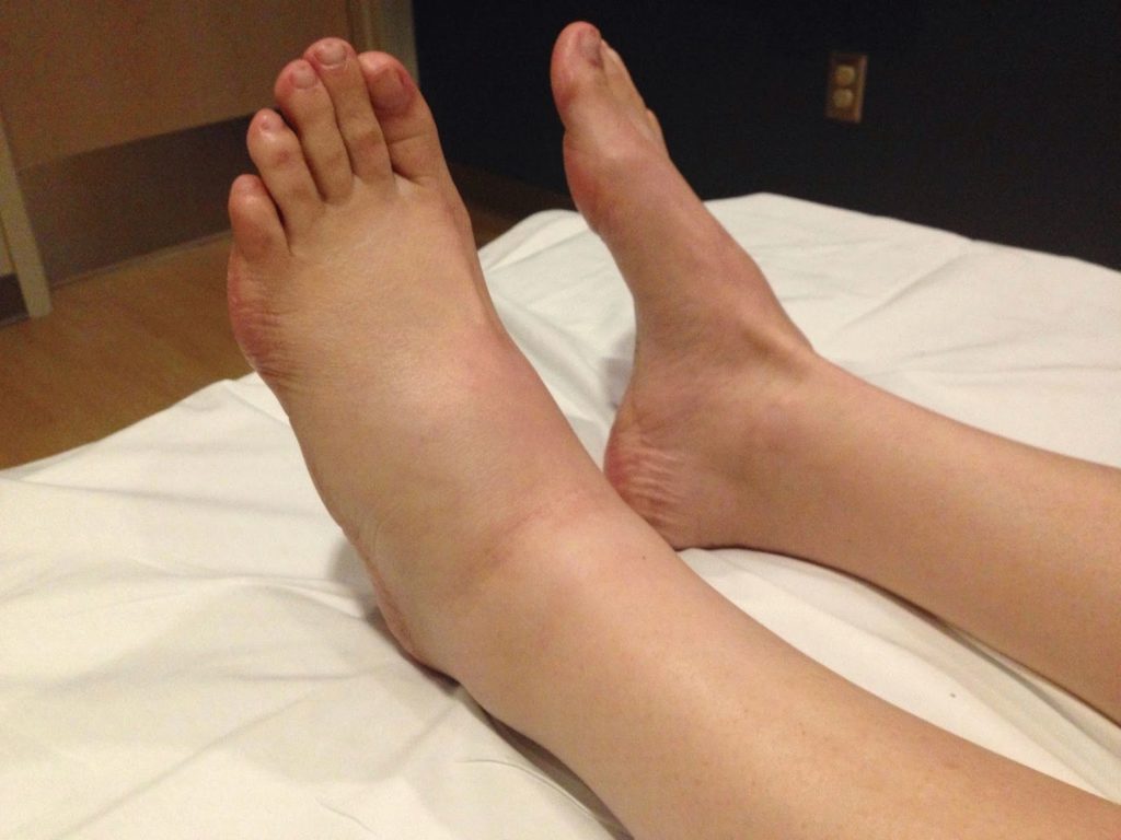 Отек ног причины лечение лодыжки thumbnail