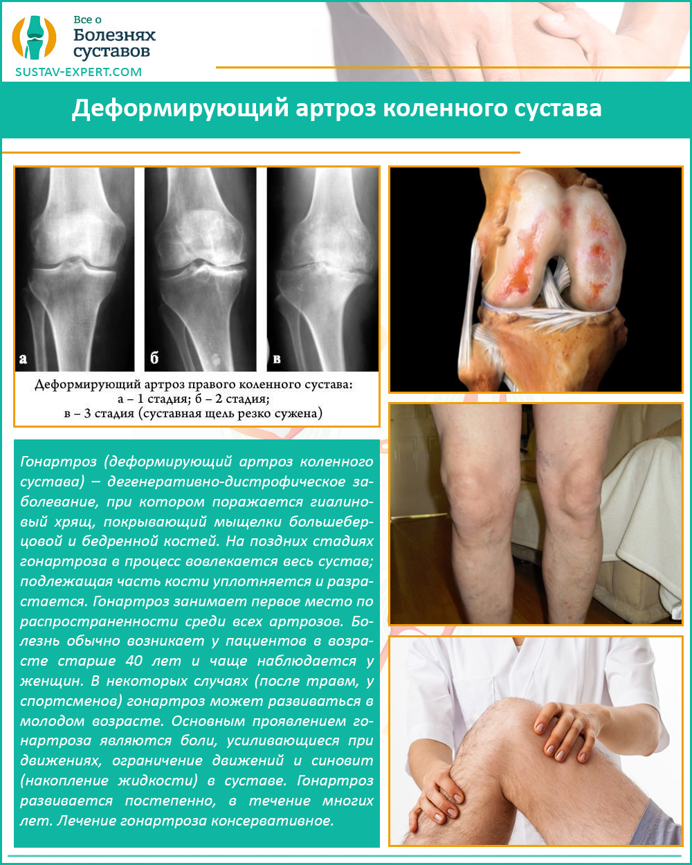 Деформирующий артроз коленного сустава