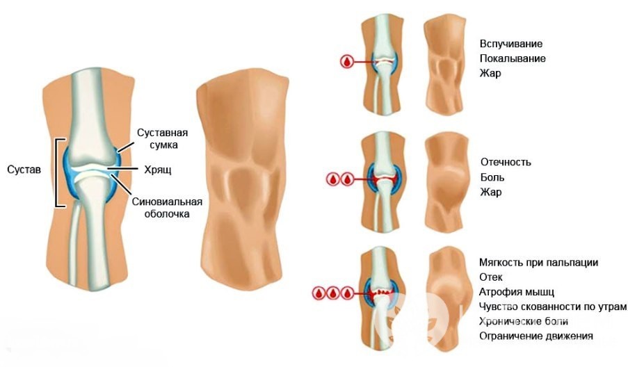 Признаки гемартроза коленного сустава
