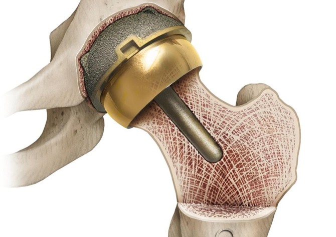 Сустав нео. Гемиартропластика тазобедренного сустава. Эндопротезирование тазобедренного сустава. Эндопротезирование тазобедренного сустава пластика кости. Ревизионное эндопротезирование тазобедренного сустава.