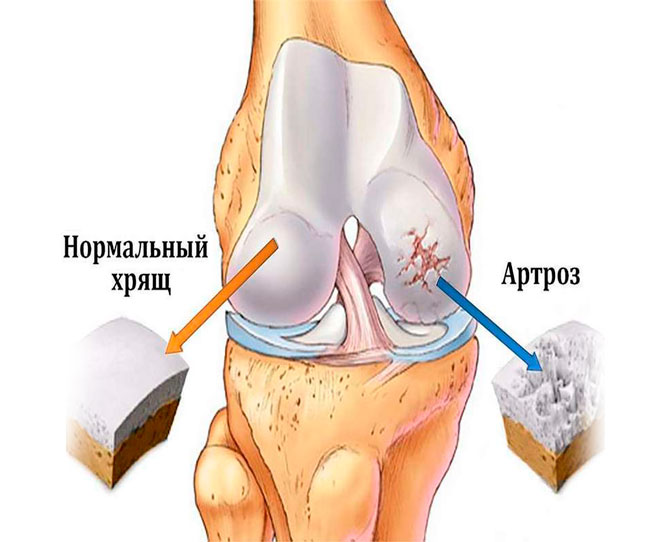 Артроз болят мышцы ног