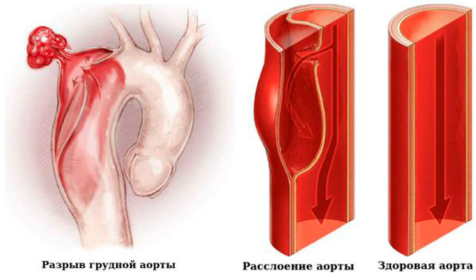 Расслоение аорты