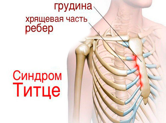 Болит спина в районе ребер с двух сторон