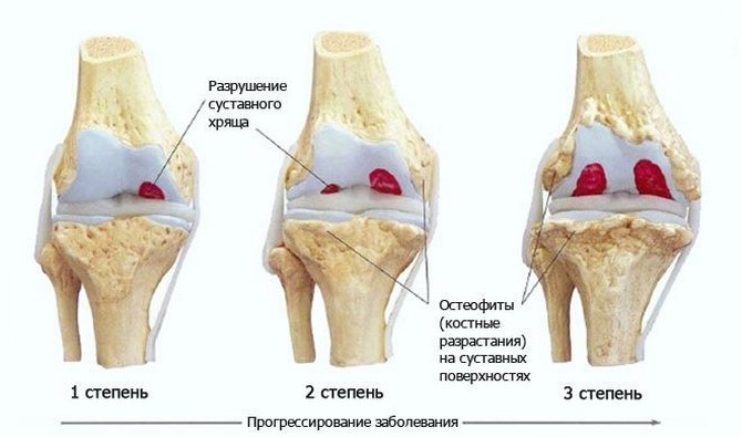 Гонартроз коленного сустава