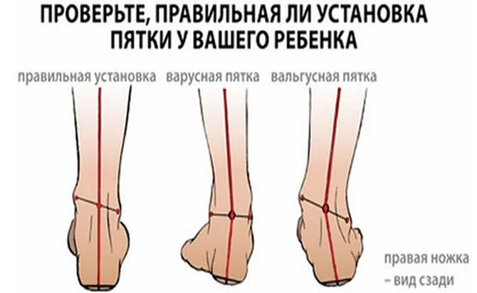 Как вылечить голеностопные суставы ног
