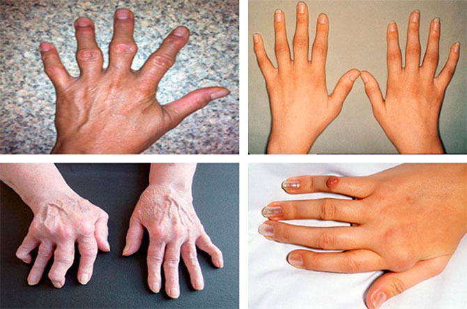 Ревматоидный артрит рук