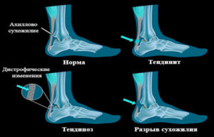 Ахиллово сухожилие фото где