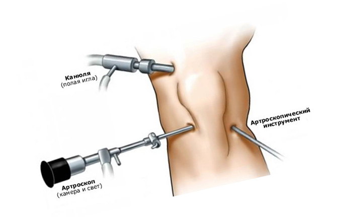 Артроскопия на колене