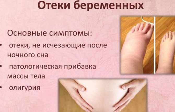 Отеки у беременных