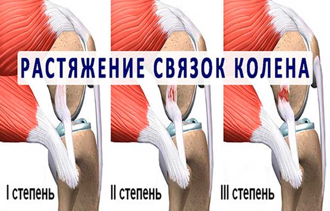 Степени растяжения связок колена