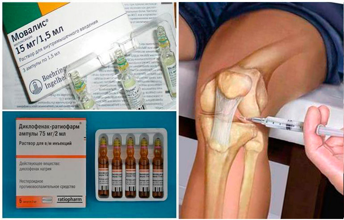 Симптоматическое лечение подагры колена
