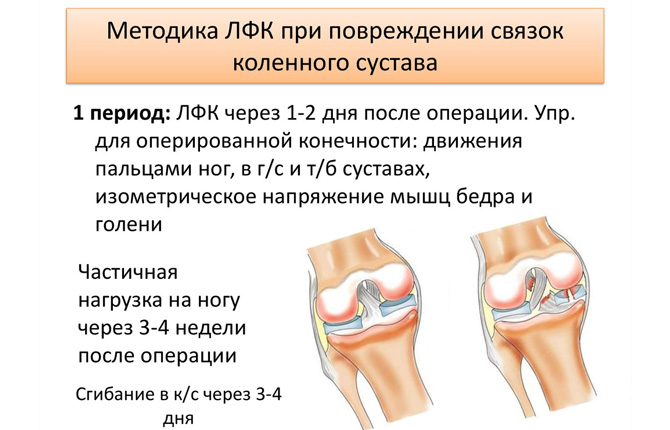 Методика ЛФК при повреждении связок колена