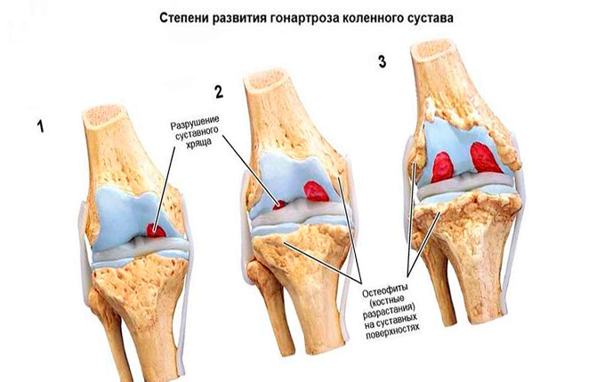 Степени развития гонартроза коленного сустава