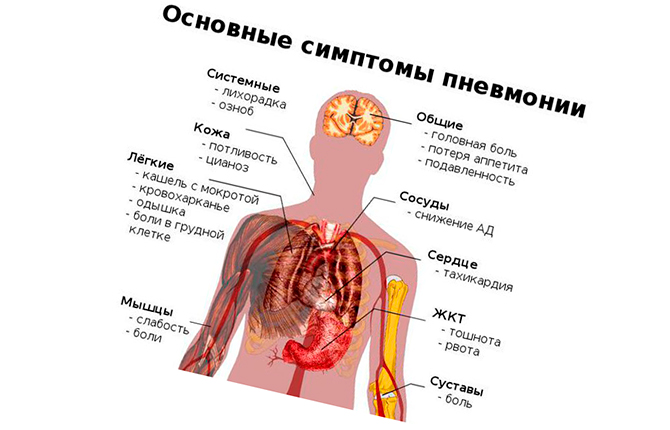 Пневмония симптомы