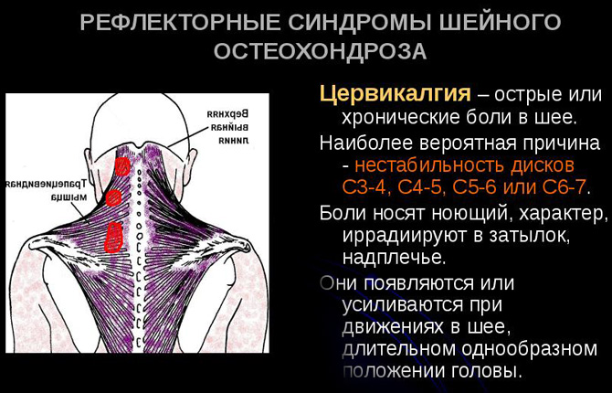 Рефлекторные синдромы шейного остеохондроза