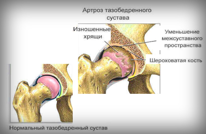 Субхондральный фиброз