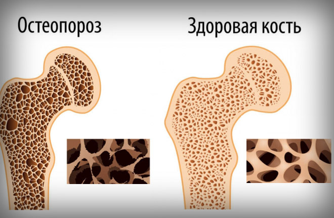 Субхондральную костную ткань